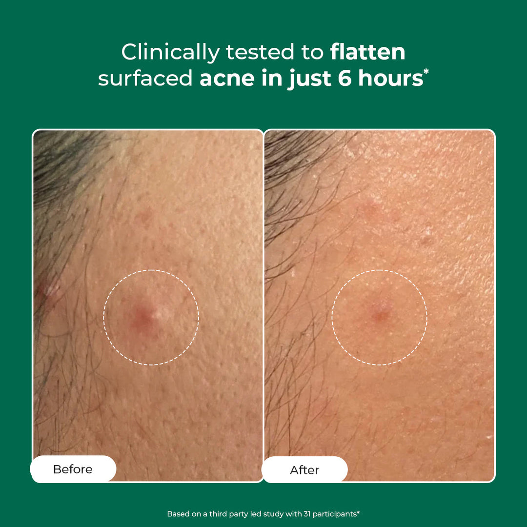 Conscious Chemist Self Dissolving Microneedle Acne Patches | 8 Patches