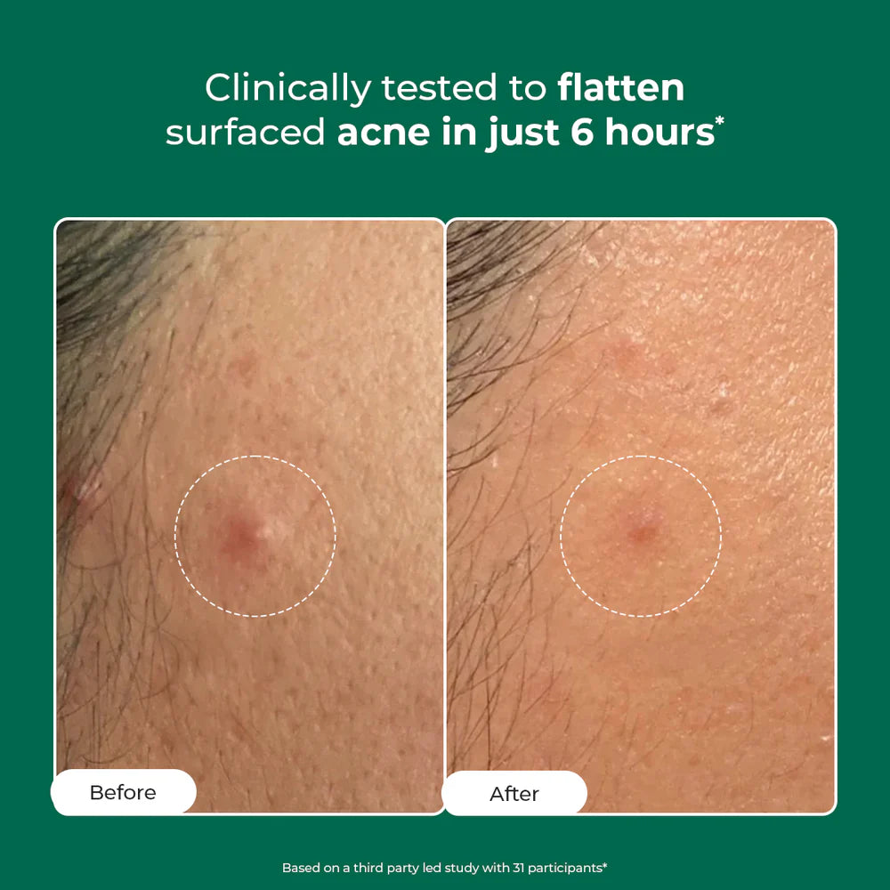 Conscious Chemist Self Dissolving Microneedle Acne Patches | 8 Patches