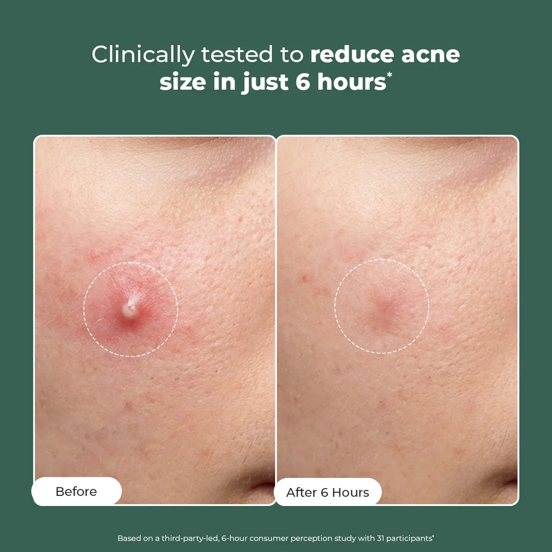 Acne Spot Corrector Gel ( Pack Of 2) | 2x15 ml