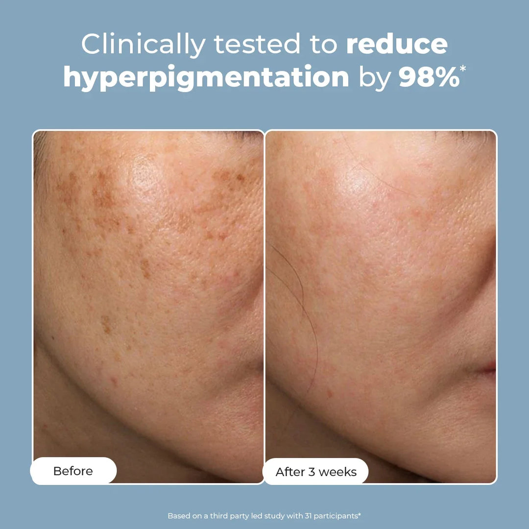 Trubiom Pigmentation & Dark Spots Treatment Serum