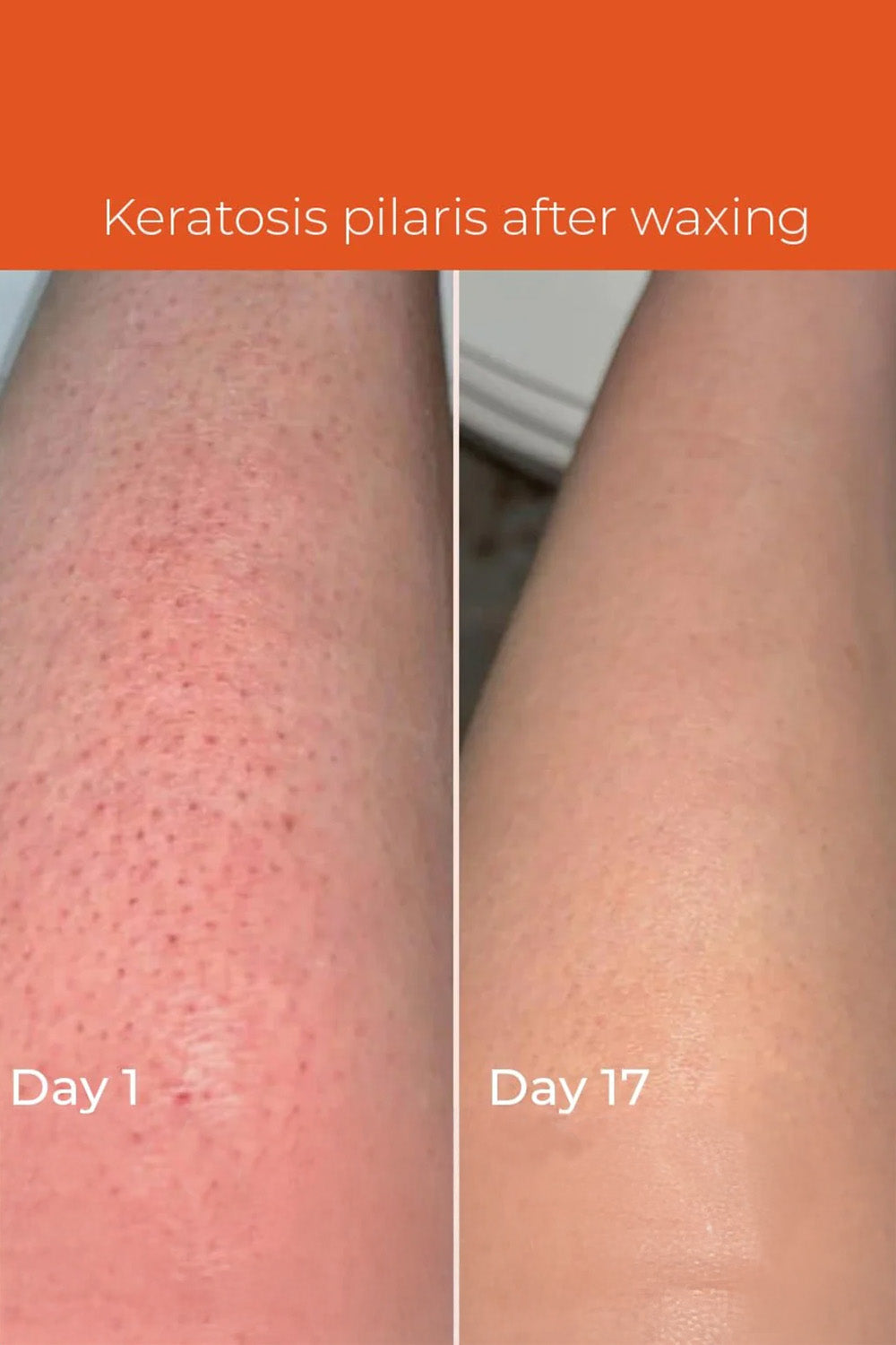 Skinvest Smoothie In-Shower Body Conditioner 150ml + Bye Bye Bumps Exfoliating Mist 50ml