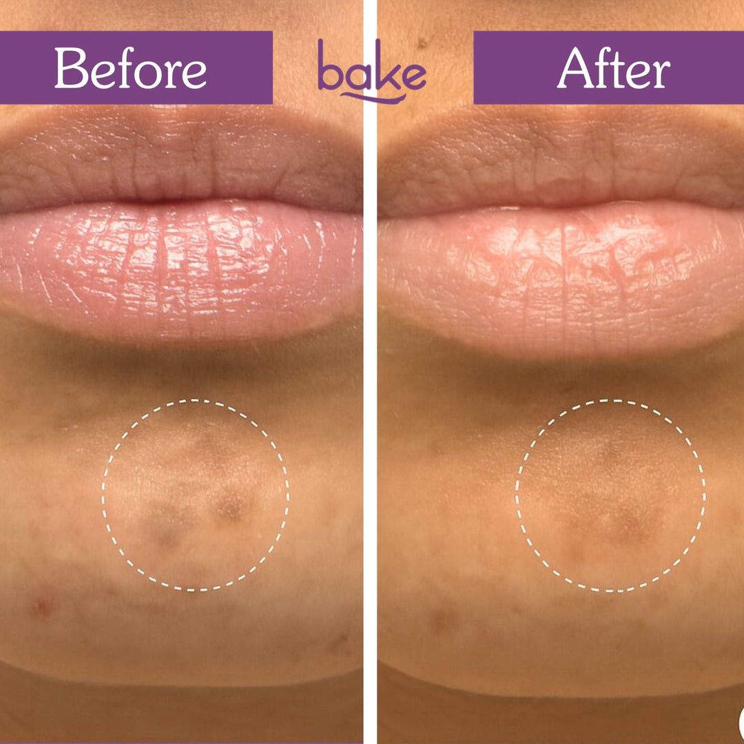 Spot Erase Micropoint Hydrocolloid Patches for Dark Spots-9 patches