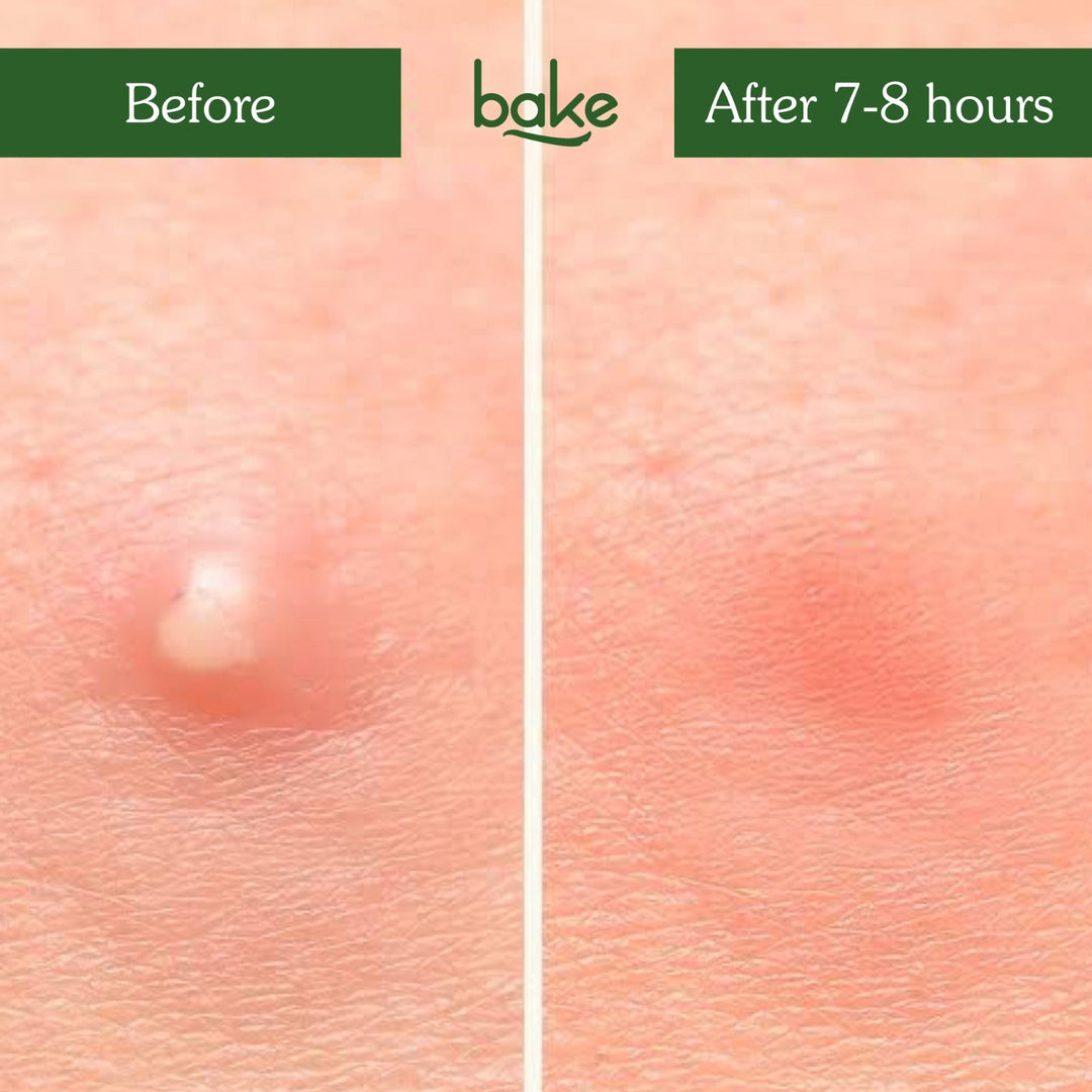 Zit Erase Micro point Patches for Active Acne & Breakouts - 9 Patches