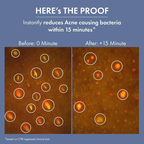 ThriveCo Goodbye Acne Kit | Anti-Acne Serum (30ml) and Face Wash (100ml) | Reduces Pimples, Acne Marks & Sebum Production | For Women & Men