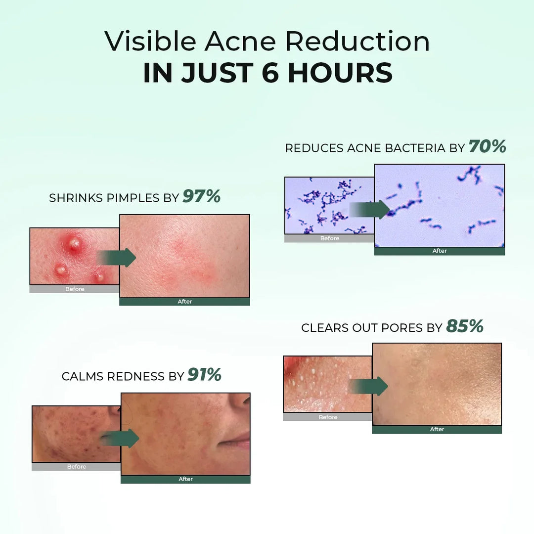 Acne Spot Corrector Gel ( Pack Of 2) | 2x15 ml