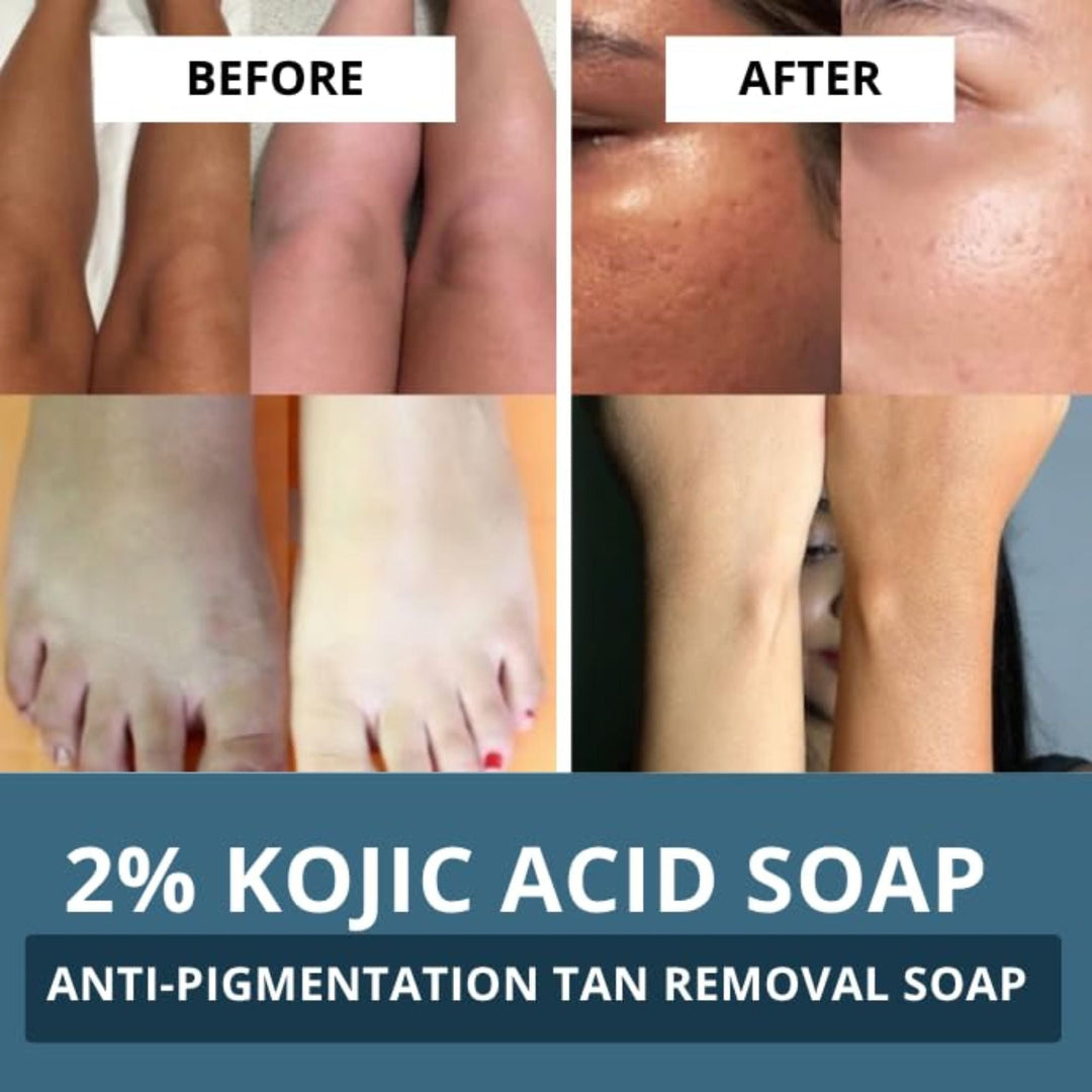 2% Kojic Acid Scrub Treatment Soap (100 Gms Pack of 3)