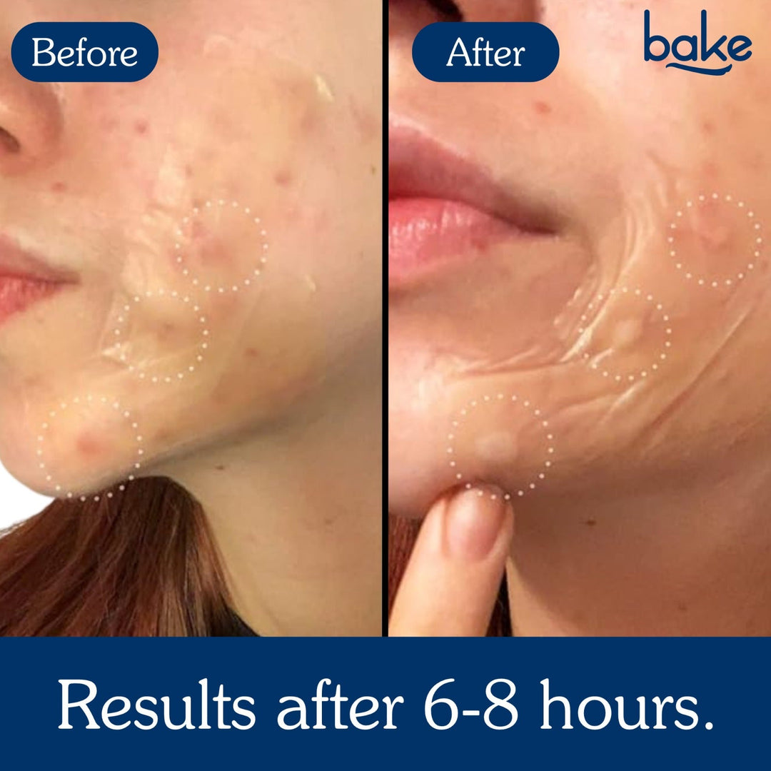 2% Salicylic Acid Pore Erase Nose Strips