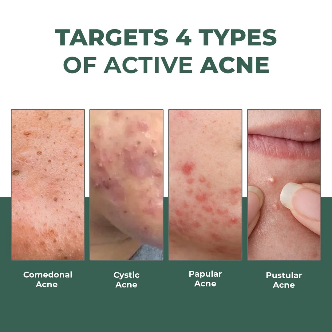 Acne Spot Corrector Gel ( Pack Of 2) | 2x15 ml