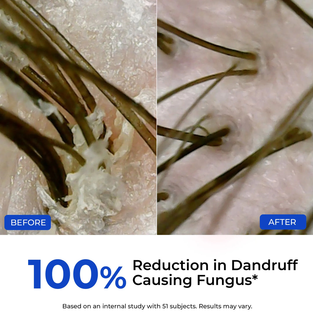 Anti-Dandruff Scalp Exfoliator