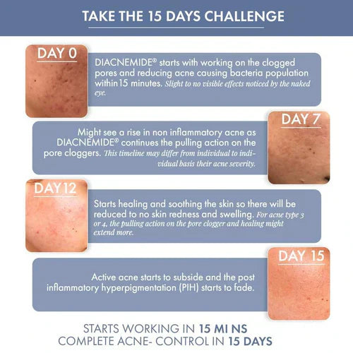 ThriveCo Goodbye Acne Kit | Anti-Acne Serum (30ml) and Face Wash (100ml) | Reduces Pimples, Acne Marks & Sebum Production | For Women & Men