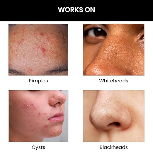 ThriveCo Goodbye Acne Facial Cleanser | Non-Comedogenic Anti Acne Face Wash for Pimples with Azelaic Acid & Witch Hazel | For Women & Men (100ml)