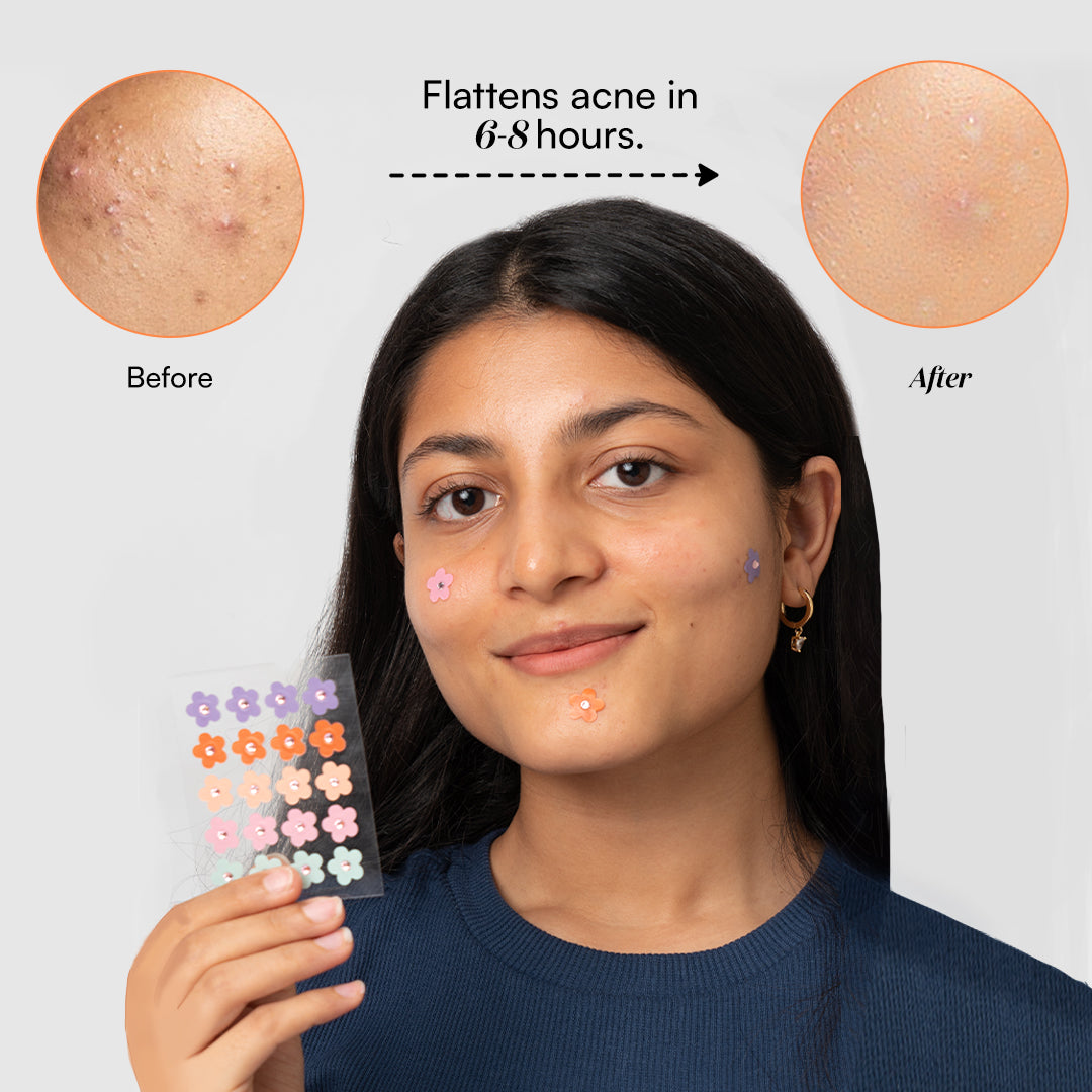 Gush Beauty Dart It Hydrocolloid Pimple Patches for Healing Acne, Zits and Blemishes - 24 patches