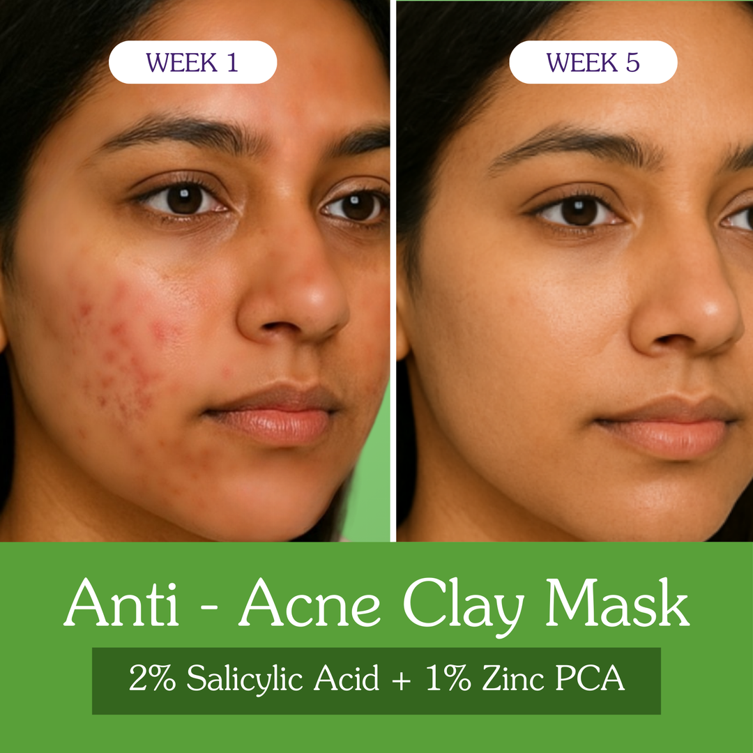2% Salicylic Acid + Zinc PCA Anti-Acne Clay Mask