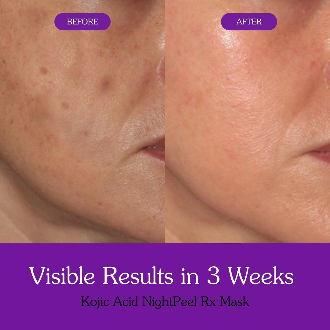 Kojic Acid + Turmeric NightPeel Rx Mask