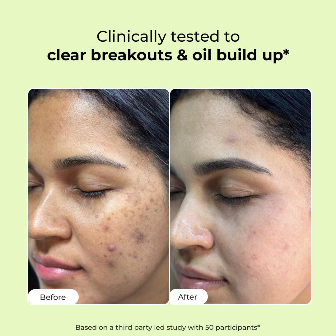 Oil Control & Acne Clearing Exfoliating Face Wash | AHA, BHA & CICA Extract
