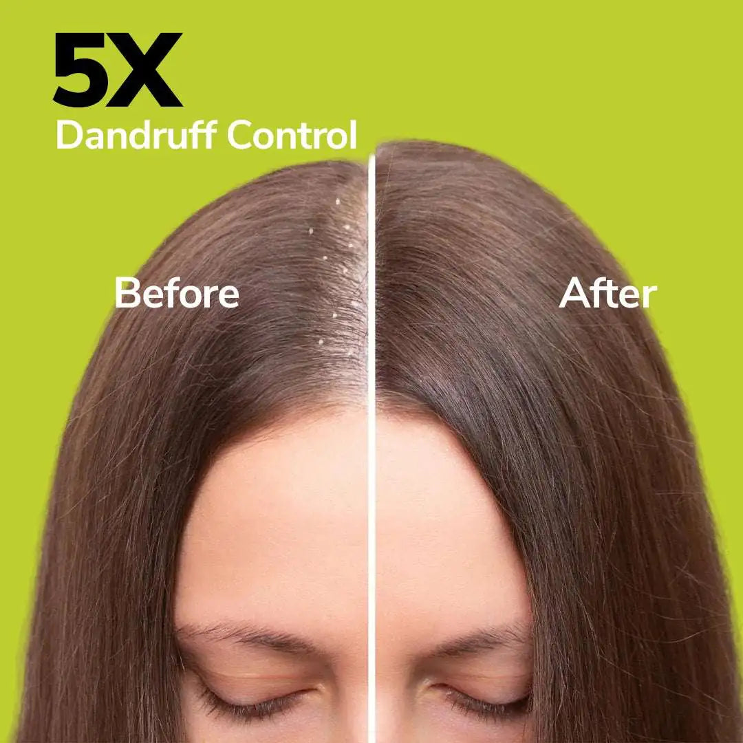 FreshLuxe Acne Control Combo | AYUSH-Approved | Salicylic Acid, Tea Tree, Neem-Aloe & Charcoal Facewash.