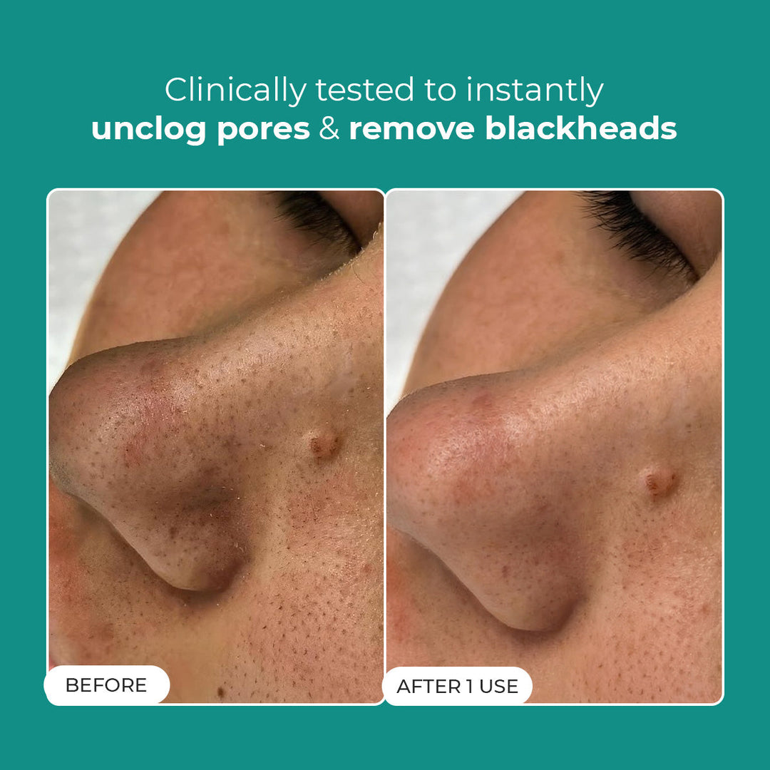 Blackhead Melting Water