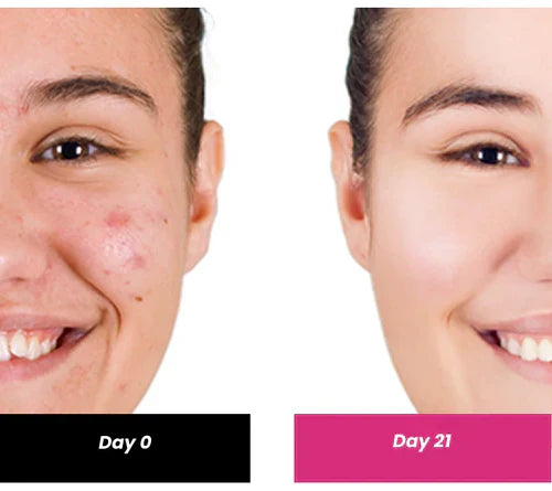 ThriveCo 2% Salicylic Acid Serum For Acne & Clogged Pores | Clears Dead Skin & Reduces Excess Sebum | For Men & Women | 30ml