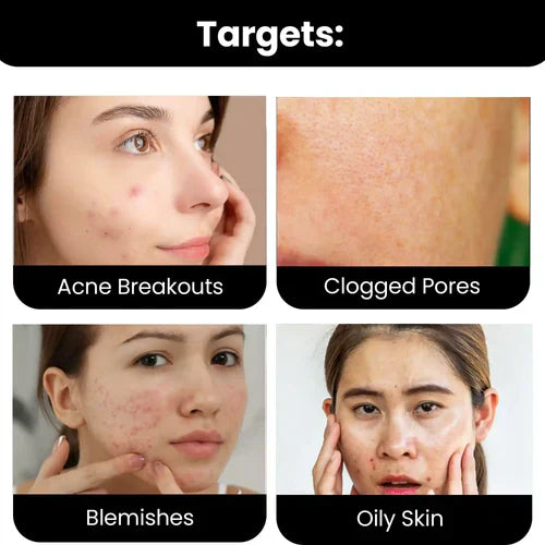 ThriveCo 2% Salicylic Acid Serum For Acne & Clogged Pores | Clears Dead Skin & Reduces Excess Sebum | For Men & Women | 30ml