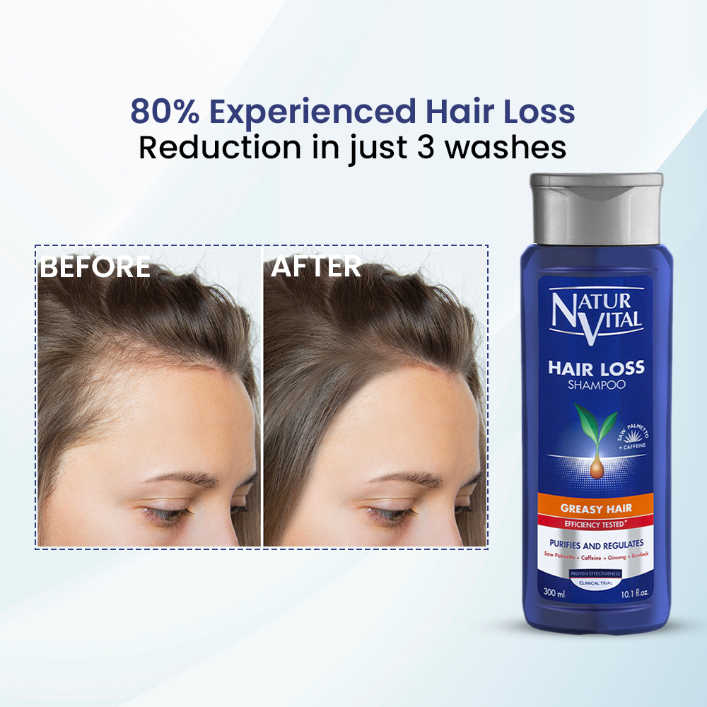 NaturVital Hair Loss Shampoo – Greasy Hair-300ml