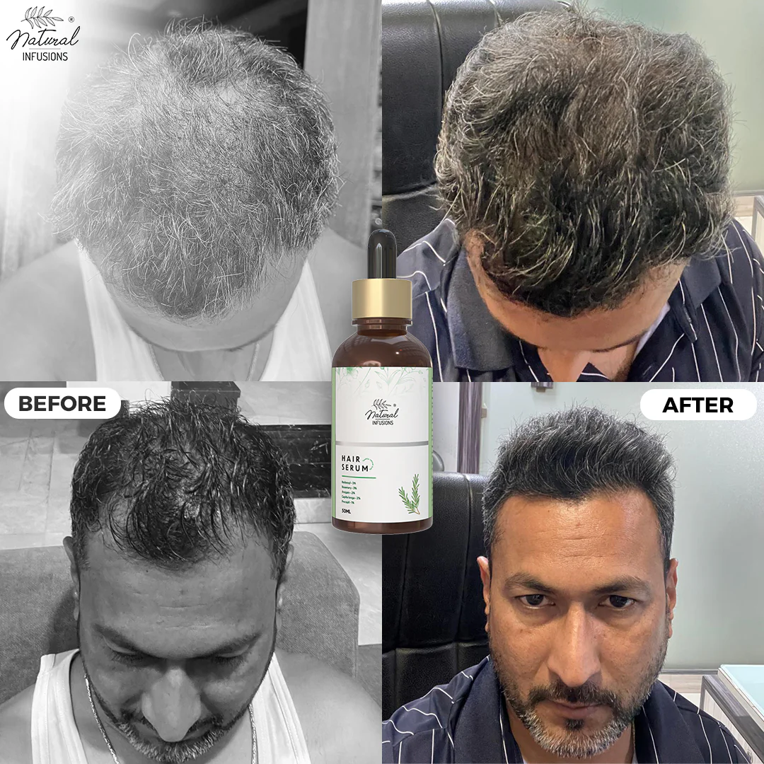 Natural Infusions Hair Growth Serum (50ml) | Redensyl, Anagain, Rosemary, Procapil, & Capila Longa | Controls Hair Fall | Increase Hair Density | For Men and Women