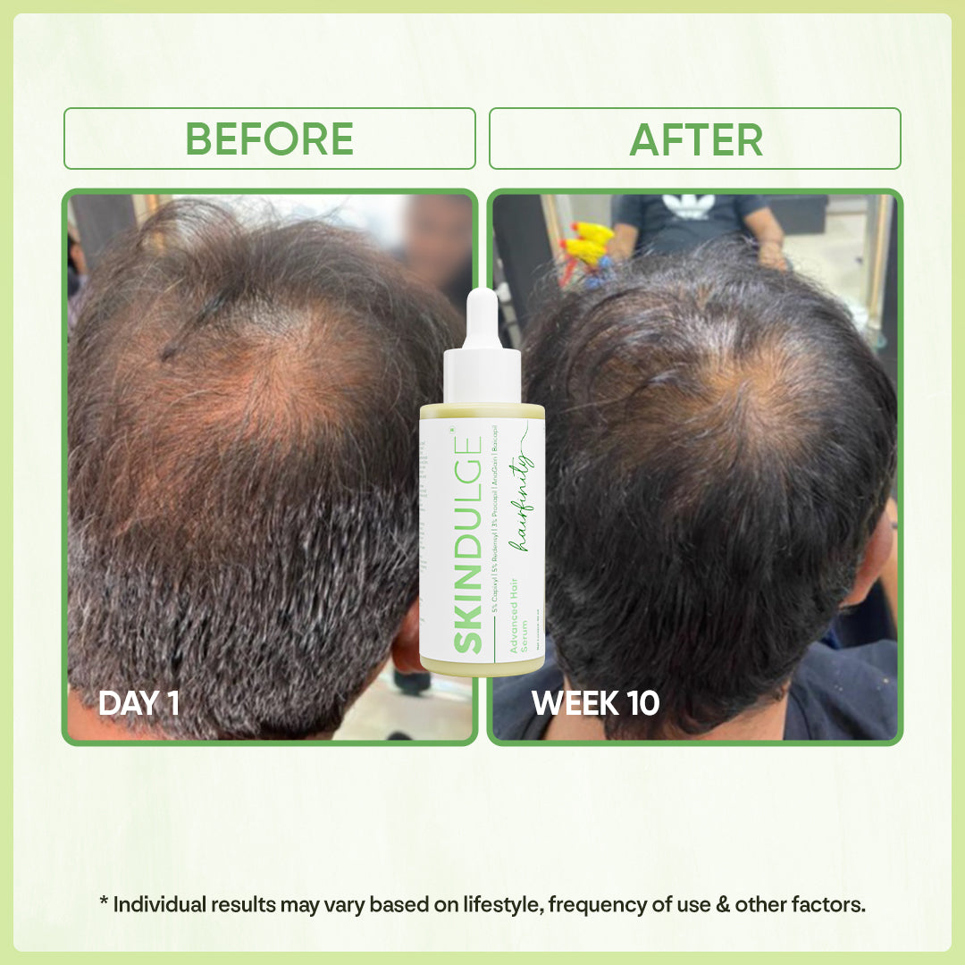 Haifinity, Advance Hair Growth Serum