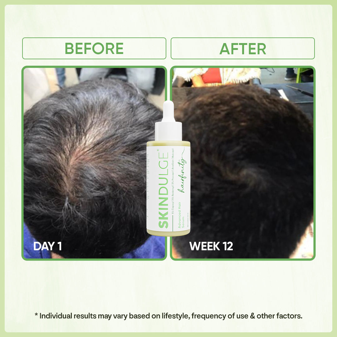 Haifinity, Advance Hair Growth Serum