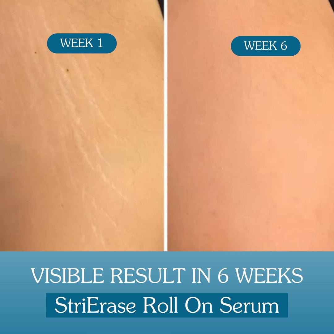 StriErase™ Stretch Marks Removal Roll On Serum - Suspire